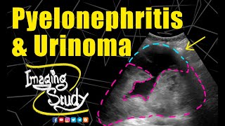 Pyelonephritis with Urinoma  Ultrasound  Case 234 [upl. by Ainek]