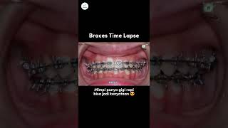 Siapa yang gak mau gigi nya serapih ini dentist doktergigi dentalclinic braces behelgigi [upl. by Notse926]