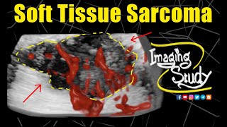 Soft Tissue Sarcoma  Ultrasound  Case 321 [upl. by Dehlia]