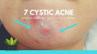 7 Cystic Acne Natural Remedies that Really Work [upl. by Warford]