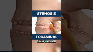 What is foraminal stenosis [upl. by Ahsiener]