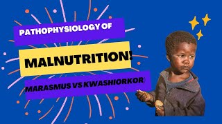 Pathophysiology of MalnutritionMarasmus VS Kwashiorkor [upl. by Sigmund]