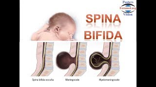 Spina Bifida les Causes et la Prévention par acide folique vitamine B9 [upl. by Erbes]