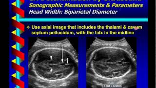 Gestational Age Determination by Ultrasound [upl. by Dnumde]