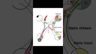 Junctional Scotoma insightophthalmology visual field ophthalmology [upl. by Nosidam392]