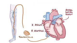 Pulmonary Embolisms causes symptoms diagnosis treatment pathology [upl. by Elleoj]