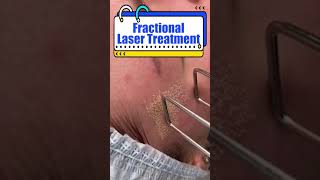 Fractional Laser Treatment Skin Tightening Therapy Laser Beauty Treatment [upl. by Iew]