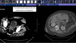 CT Urogram [upl. by Ayojal]