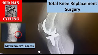 Knee Replacement amp Cycling [upl. by Dahsar251]