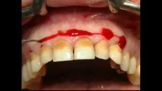 Gingival Surgery  External Bevel [upl. by Marchak129]