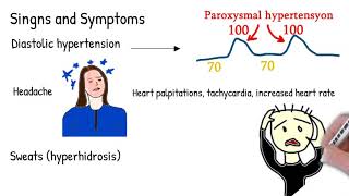 Pheochromocytoma  symptoms causes treatment made simple [upl. by Durstin]