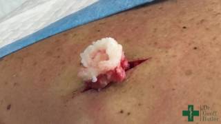 Removal of an Epidermal cyst on the upper back [upl. by Nelleoj]