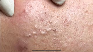 ACNE TREATMENT VU QUYNH MI  Perennial Blackheads On Girl Face 2024FULL [upl. by Ennovyahs]