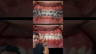 Cas ORTHODONTIE  l’INVERSÉ d’occlusion DENTAIRE [upl. by Amund]