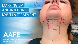 Marking Up and Injecting Kybella [upl. by Barbi]