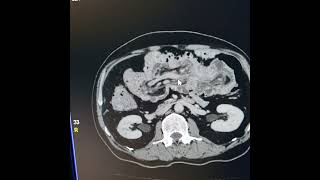 Ileocolic intussusception with lipoma as a lead point [upl. by Candyce50]