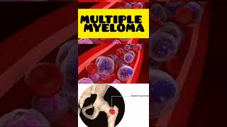 Multiple myeloma multiplemyeloma malayalam cancer hypercalcaemia high calcium genetics [upl. by Artep]