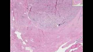 Histopathology ProstateAdenocarcinoma [upl. by Keely306]