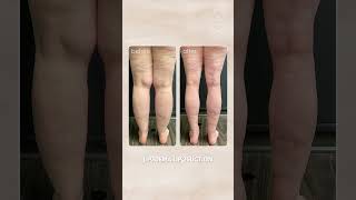 Lipedema Liposuction Before amp After  Salameh Plastic Surgery Center [upl. by Adnavoj]