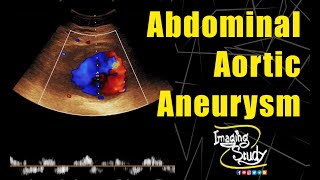 Abdominal Aortic Aneurysm  Ultrasound  Doppler  Case 139 [upl. by Jillane585]