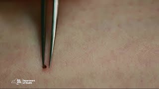 Proper Tick Removal [upl. by Short498]