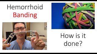 What is a hemorrhoid banding I show you how its done [upl. by Selegna]