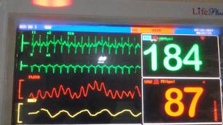 Supraventricular arrhythmias ecginterpretation ecgmadeeasy ecg ekg medicineexplained [upl. by Aivon426]