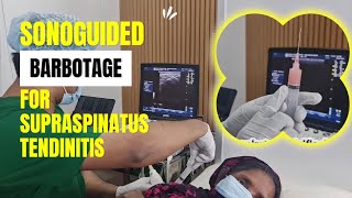 Sonoguided barbotage technique  For Supraspinatus Calcific Tendinitis [upl. by Sollars]