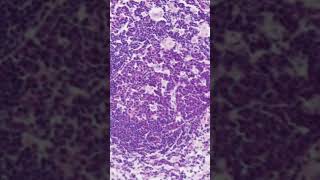 Toxoplasma Lymphadenitis Histology [upl. by Ffej836]