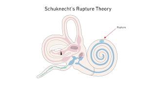 Menieres Disease A New Theory [upl. by Waldos]