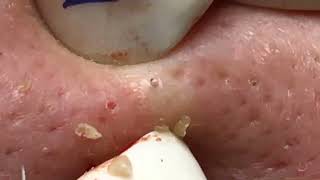 Pimple popping videos 2022 blackheads youtube [upl. by Cullie]