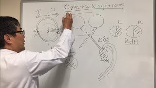 Optic Tract Syndrome [upl. by Lantha]