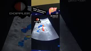 A case of portal hypertension with collaterals channel formationdoppler day 24 [upl. by Figge40]