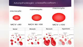 ANEMIA  CLASSIFICATION [upl. by Princess]