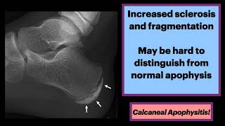 Calcaneal Apophysitis MSK Radiology Orthopedics [upl. by Landa]