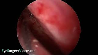 Mucosal flap creation in endo nasal DCR [upl. by Arebma]