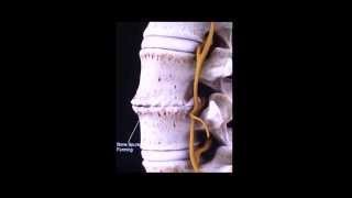 Discopatía degenerativa lumbarDegenerative disc Lumbar spine [upl. by Anivid]