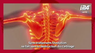 LA MINUTE SANTE  La polyarthrite rhumatoïde origines symptômes et traitements [upl. by Dove284]