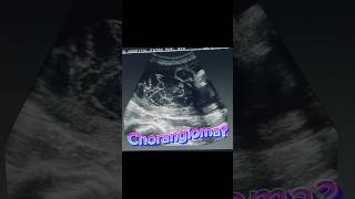 Placenta Mass  Chorangioma  Normal Fetal Scan  Anomaly Ultrasound [upl. by Tristas]