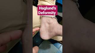 Haglunds Deformity Retro Calcaneal SpurDr Sai Chandra [upl. by Nomaj]