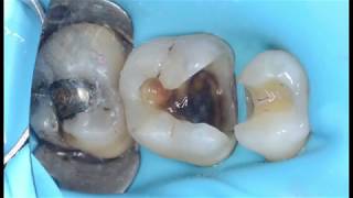 Selective caries excavation the only correct clinical approach [upl. by Meingoldas]