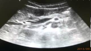 Sonographic view terminal ileitis [upl. by Lipp]