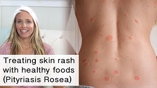 Treating skin rash and inflammation with healthy foods Pityriasis Rosea [upl. by Eedebez409]