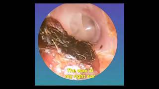 Ear hd video otoskop [upl. by Ahkihs]