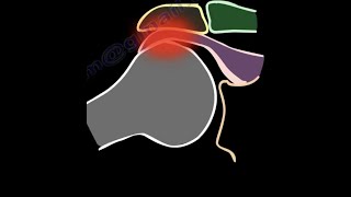 Shoulder Impingement Syndrome diagnosis and treatment shoulder pain shoulder bursitis cuff tears [upl. by Aneba]