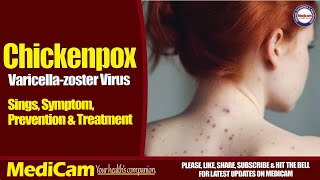 Chickenpox Signs Symptoms Prevention And Treatment [upl. by Esac]