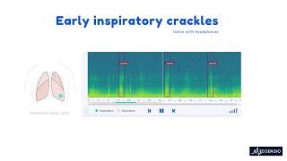 Lung sounds  Early inspiratory crackles [upl. by Sugihara410]