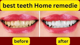 quotEffective Teeth Whitening Home Remedies for a Brighter Smilequot [upl. by Hills]