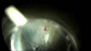 Laser Peripheral Iriditotomy to Prevent Glaucoma Part 2 [upl. by Ahsinit]