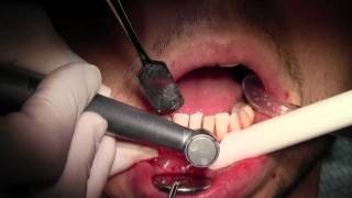 Extraction 2425 with Bone Grafting of Sizeable Defect Atraumatic Extractions [upl. by Jona407]